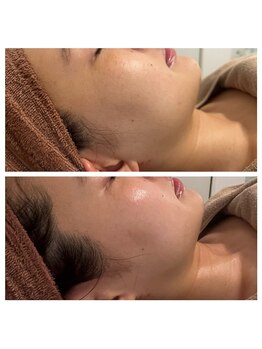 美温(mion)/インディバフェイシャル