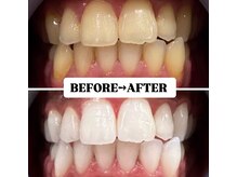 ホワイトニングサロン 豊中/Before&After美白ホワイトニング