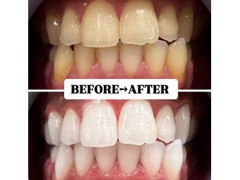 ホワイトニングサロン 豊中/Before&After美白ホワイトニング