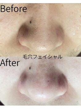 ベルミーランド MEGAドン・キホーテ桐生/フェイシャル Before→After