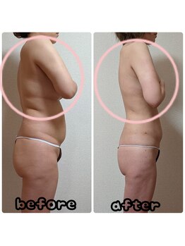 リセル(Re-Cell)の写真/【お正月太りをリセット!】特殊ジェルのリンパマッサージで二の腕引き締め★肩こりによる厚みもスッキリ!