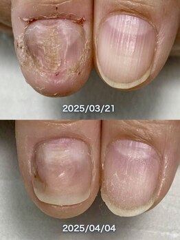 ポメロ(POMELO)/2週間でも爪周りの皮膚の改善！