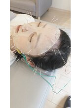 経堂鍼灸整体院/幹細胞美容鍼の場合