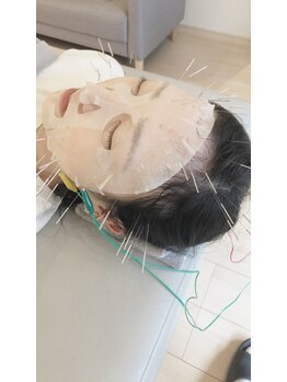 経堂鍼灸整体院/幹細胞美容鍼の場合