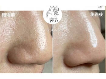 テテメルティ(te-te melty)/ざらつき肌のお悩み改善方!