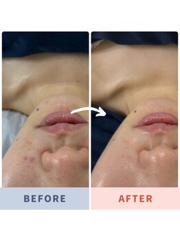 アリュール 京都烏丸御池店(ALLURE)/ハーブピーリング #ニキビケア