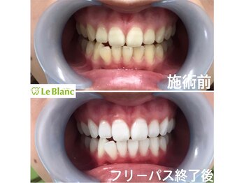 ルブラン 奈良店(Le Blanc)/お口元美人に。。。