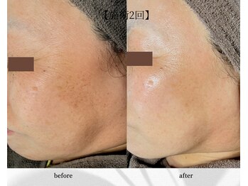 アン ビューティー(ann beauty)/施術2回【症例写真】60代