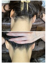 エミュ(emu)/うなじ脱毛