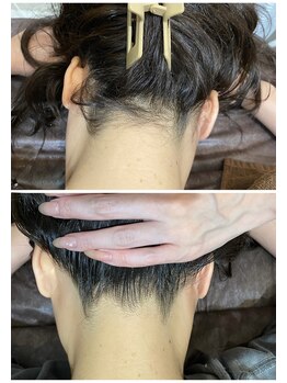 エミュ(emu)/うなじ脱毛