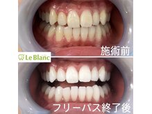 ルブラン 奈良店(Le Blanc)/お口元綺麗ですか？