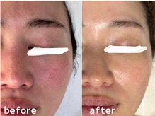 フォー(For...)/肌改善・美白ケア◇ララピール