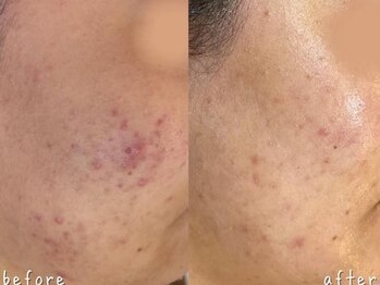 エヌエースキン 北谷店(NAskin)/ハーブピーリング｜ニキビケア