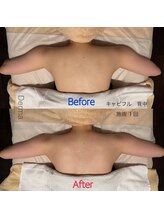 ダーマ(Derma)/キャビフル 背中 Before＆After