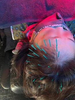 メディカルジャパン 吉祥寺/自律神経症状に対する頭皮鍼