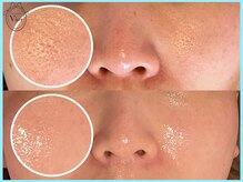 ハーブピーリング 名古屋/肌が整いツヤツヤなお肌に！