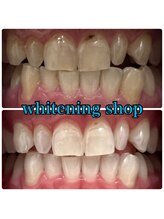 ホワイトニングショップ 三田店/before after