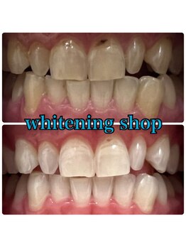 ホワイトニングショップ 三田店/before after