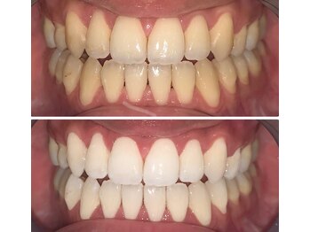 ホワイトニングビューティー つくば店の写真/お顔の悩みをまとめて解消◎お肌だけではなく口元のケアも♪ホワイトニングで清潔感もUPする輝く白さへ！