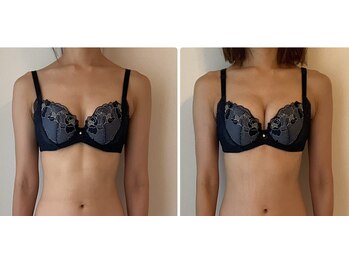 美バストアルファ(美bust α)/【バストアップ】症例