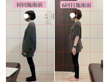 弁天町駅前整体院/猫背矯正6回目の症例