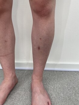 ロイビー(loeyB)/脱毛1目回から1ヶ月後