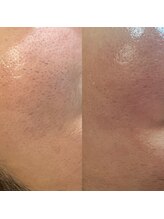 リネン(Lien)/顔の産毛脱毛はwax！