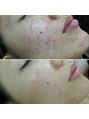 ビューティービューティー(beauty×beauty) ニキビでお悩みの方は当サロンにお任せください★結果出します!
