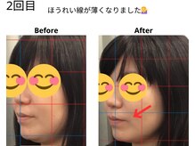 ベル/30代の方の小顔Before After