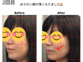 ベル/30代の方の小顔Before After