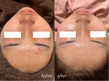 ティアラッシュ(TiaLash)/肌質改善ハーブピーリング