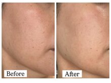 エクラルム(Eclaleum)/BeforeAfter　Silk Skin