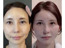 ココ(COCO)/口横たるみ/頬こけ/リフトアップ