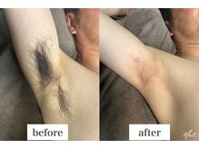 ムート(Mut.)/メンズ脱毛／脇