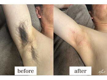 ムート(Mut.)/メンズ脱毛／脇