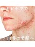 【ニキビケア・肌荒れ】本気の肌質改善フェイシャル　初回6,600円