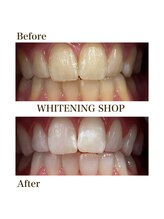 ホワイトニングショップ 元町 中華街店/美白ホワイトニングBefore&After