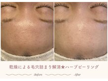 エステティックサロン シーズ/ハーブピーリング１回の効果