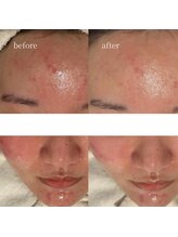 アーネスト 大阪心斎橋店(EARNEST)/韓国式光美容【 敏感・肌再建 】