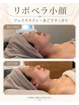 ジョワ 黒崎店(joie)の写真/【ボディーにも】輪郭形成小顔たるみケアには脂肪分解リポベラ、レッドショットフェイシャル