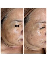 リンデザ(LINDEZA)/ハーブピーリング/肌のトーンUP