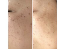 【結果重視のシミケア】薄いシミも改善◎肌に優しく痛みも少ない