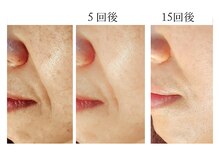 エボルブ 四条烏丸店(EVOLVE)の雰囲気(老け顔解消リンパ&ヒト幹細胞でホウレイ線もふっくら!)