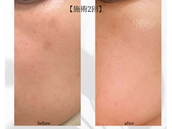 アン ビューティー(ann beauty)/施術2回【症例写真】