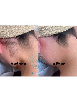 サロンアメリ イオンモール綾川店(Salon Ameri)/香川　うなじ脱毛　アメリ