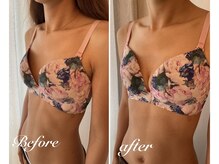 美バストアルファ(美bust α)/【バストアップ】症例