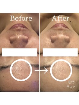 ディースズ(D.suzu)/ハイドロ毛穴洗浄before/after