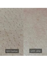 サラサ(SARASA)/背中脱毛