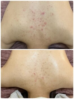 ヴェールココン(Veil Cocon)/BODYダブルピーリング