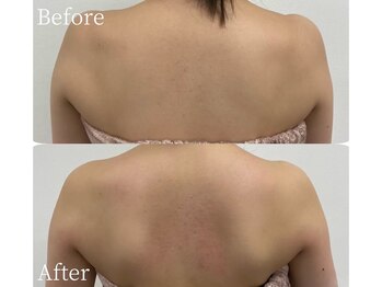 ミスティア(mistia)/エステ 背中1回